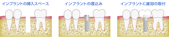 インプラント治療