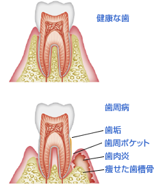 歯周病