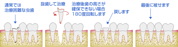 再植